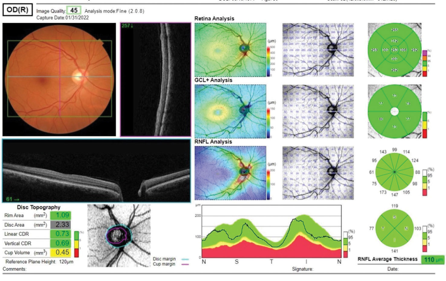 Several metrics are available for evaluation of a glaucoma suspect, including the ganglion cell layer analysis and the RNFL analysis. Also noted are disc topography metrics.