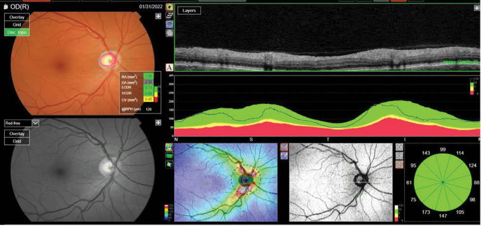 The reference database plots of the patient’s RNFL circle scan in an NSTIN format. Metrics of the right optic nerve raised questions; namely, a larger cup-to-disc ratio than seen clinically.