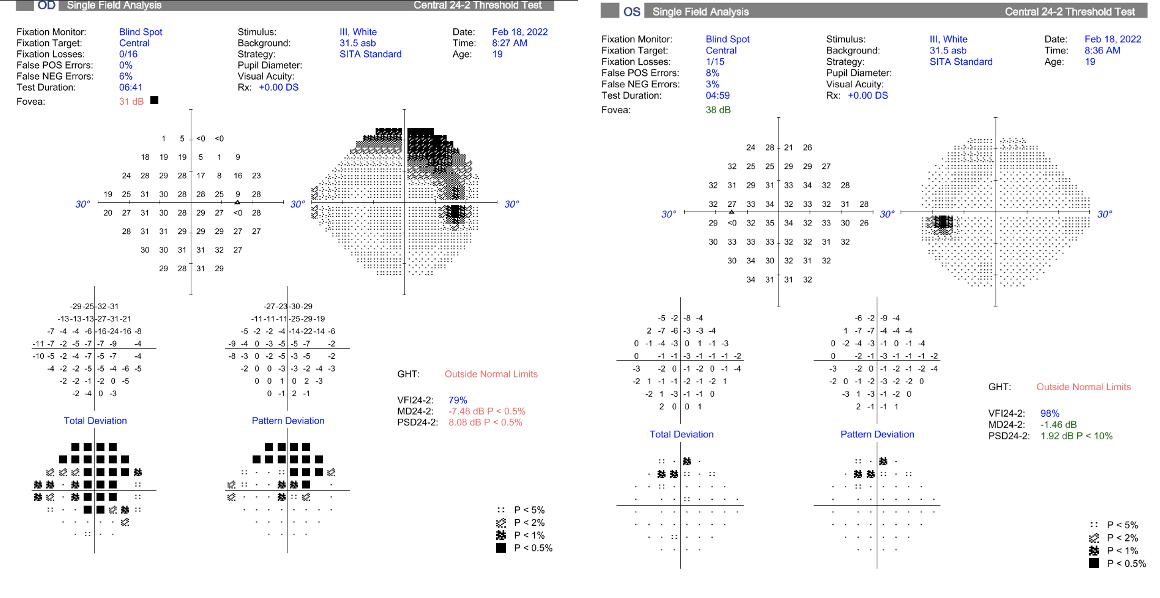 Figure 8. Visual field of right eye (left image) showing superior temporal arcuate defect extending from optic nerve head correlating to area of myelination. Left eye (right image) shows scattered defects.