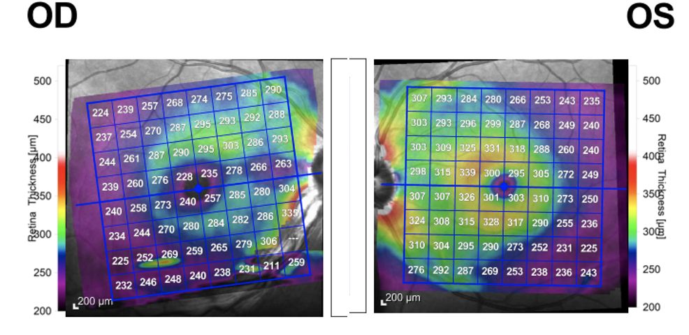 Figure 7. Four-month follow-up: Macular OCT shows retinal thinning of the right eye compared to the left eye leading to decreased visual acuity in this patient. 