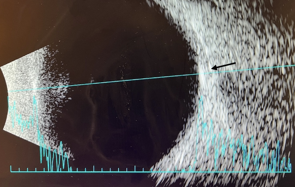 Figure 5. B-scan of right eye. A B-scan was performed on the right and left eye with similar findings in both. Retinal lesions were noted to be hyper-echogenic and hyper-reflective flat lesion on A and B scan (arrow). 